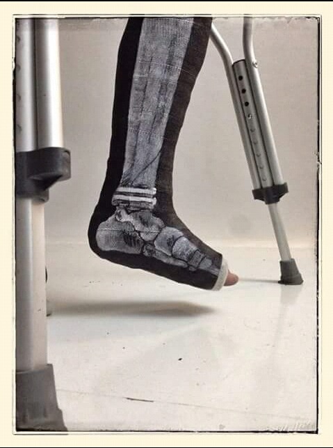 blazepress:  “My artist buddy painted his daughters broken leg x-ray onto her cast. Pins and all.”