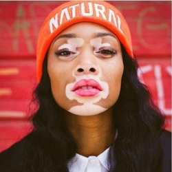 modified-minds:  johnwatsonspornstache:  bongmeblazer:  brittanybatman:  veriknawty:  Vitiligo is fascinating. Each person has their own unique style…  I love it, this isn’t a disease. This is nature’s artwork on a human beings skin.  I have this