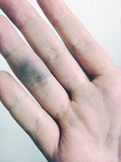 An hand der flecken blaue Totenfleck