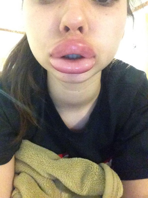 queenruune:  coutois:  soulofanonyx:  The pics you see above were taken from a Twitter hashtag called the #kyliejennerchallenge Funny how black people were caricatured for having big lips & now Kylie Jenner is doing it so its “trendy” kind of