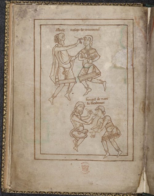 Cautery and surgical diagrams from the Harley 1585 MS.Cautery was a treatment for the relief of pain