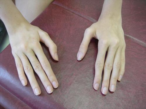 spookyalfie:  Arachnodactyly, or “spider fingers”, is a condition in which the