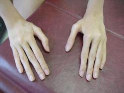 spookyalfie:  Arachnodactyly, or “spider fingers”, is a condition in which the fingers are abnormally long and slender in comparison to the palm of the hand. 