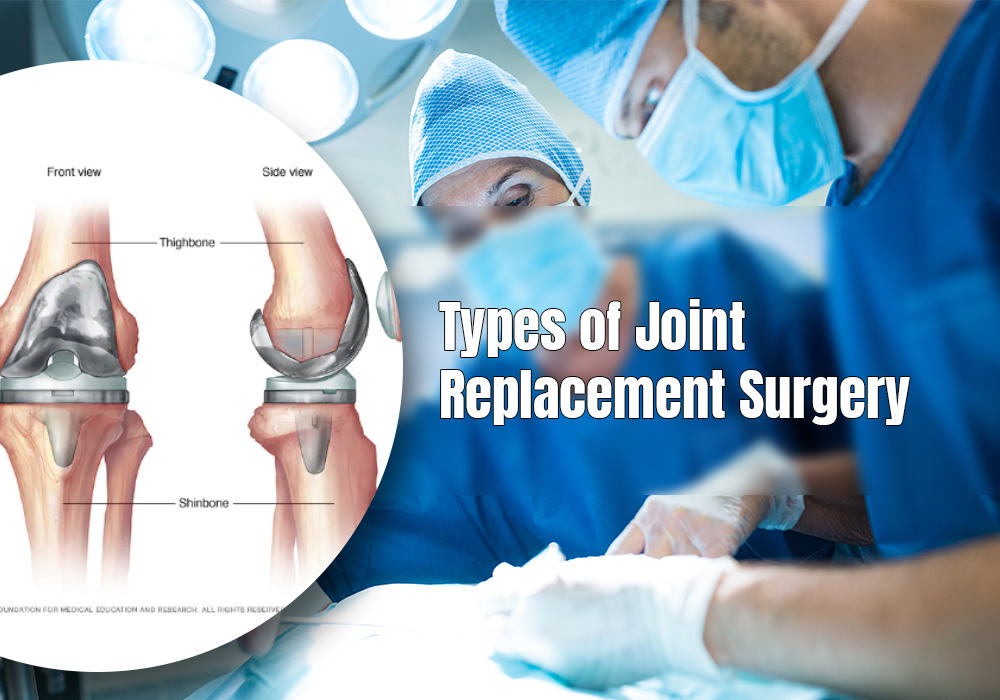 Types of Joint Replacement Surgery