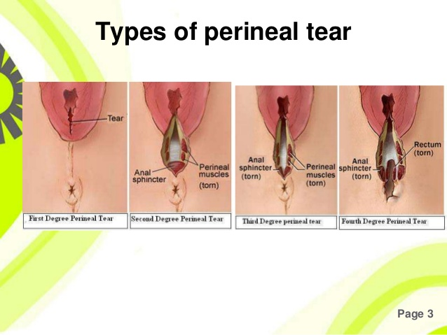 What are vaginal tears