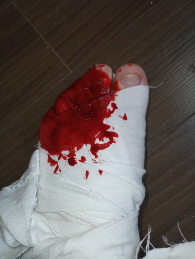 user frnkieroismydaddy's left foot wrapped in bandages. their feet are size 8 US women's and pale. their two largest toes are visible but the rest are covered in bandages which are stained in face blood that covers the top left corner of the foot