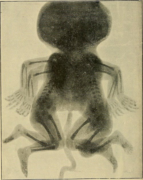 Conjoined twins foetus, The Röntgen rays in medical work, 1907 