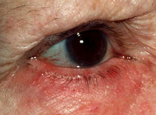 voulx:  Types of Rosacea: Eye Irritation