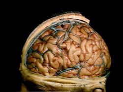 thecadaverousportrait:  A dissection which has removed the scalp, skull and dura to show the cerebral veins and cortical arteries of the left cerebral hemisphere. (Copyright: Stanford School of Medicine Lane Medical Library) 