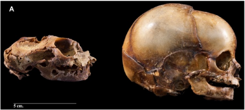 theolduvaigorge: Alterations of skull bones found in anencephalic skeletons from an identified 