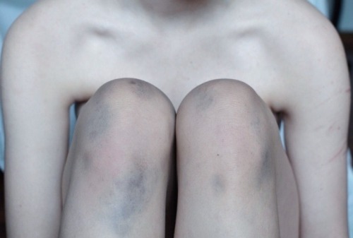quvke:  More bruises than friends 