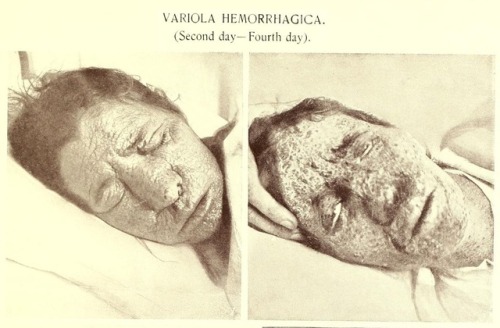 “Showing upon the face and cheeks a form of the disease commonly known as ‘black smallpox.’ (&hellip