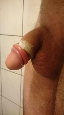 cutviking:  Day 5: the tapeband isn’t looking nice underneath,  and my inerskin is swollen and werry sensitive.  The cock adjusting to its improved state