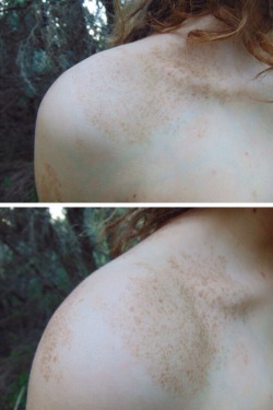 soulescaper:  So, I have this friend and she has this kind of birthmark around her shoulder and she used to hate it but we all agree it’s beautiful, isn’t it?