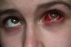 heat-vents:  heat-vents:  i had eye surgery