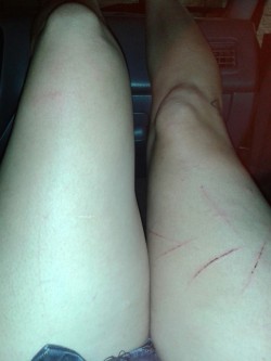 I self harmed a couple days ago. I like thigh