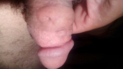 Schweinepimmel nach dem Nadelziehen