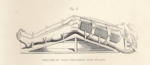 detail from a plate from a 19th century encyclopaedia c1880Fractures