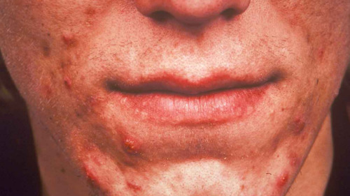 RT: Acne pode ser confundida com outras doenças de pele; saiba a quais sinais ficar atento http://dl