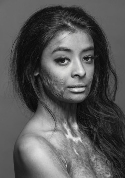 blue-wrist:This beautiful model, a burn survivor, did this photo shoot to, in her own words, “prove that scars do not change a person, they make that person who they become.” What a gorgeous woman.