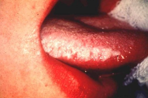 Porn Pics feralcattery:  Leukoplakia 