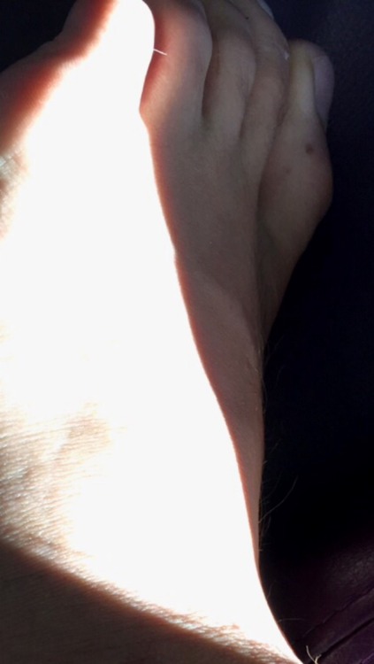 bestofbiebersfeet: HQ broken foot look at that skin on the heel