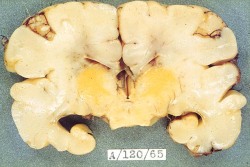 cluelessmedic:  Kernicterus  post-mortem specimen showing bilirubin deposition in the basal ganglia (yellow deposits) a complication of neonatal jaundice, long term complications include learning disability, hearing loss, movement disorders avoided