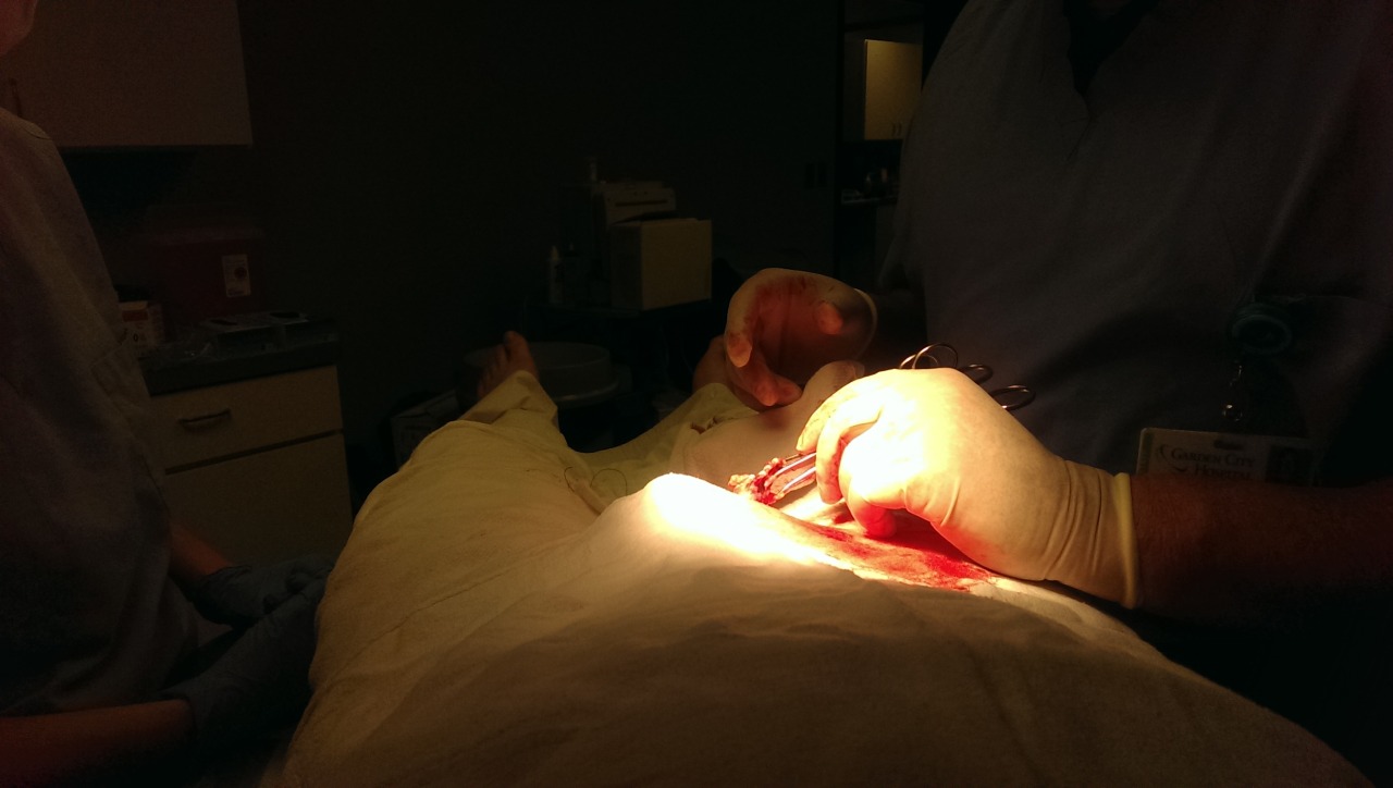 miah-akston:  Before&gt; during&gt;removed&gt;diapersftw&gt;incision&gt;swollen&gt;superlongdraintube