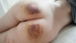 princesssparklecunt:  Bruises remind me that