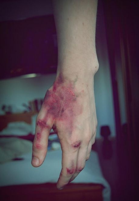 kisskissmollys-lips:Bruised hands collection