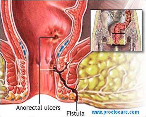 The Anal Fistula of King Louis XIV,In 1685, King Louis XIV of France began to feel a terrible pain f