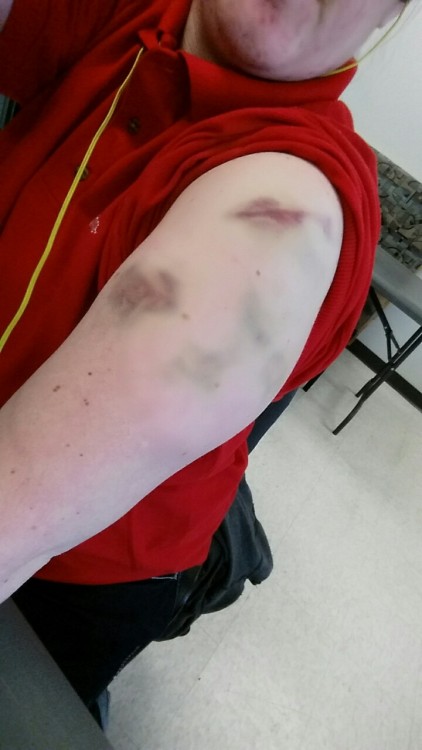 sirslilcumslut: My bruises 3 days later Submit n.n!