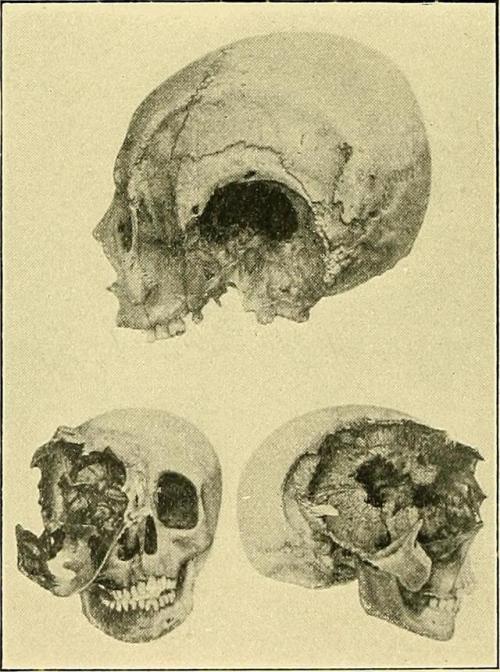 deathandmysticism: Destruction of skull by malignant disease, Some points in the surgery of the brai