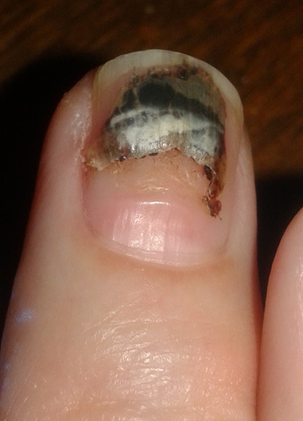 I’ve been keeping track of this, and it’s just getting grosser by the day. Long-dead blood is flaking out from both sides. Parent!Nail is half-rotted and half-clinging to my quick, whereas Child!Nail is steadily growing in its parent’s wake.(No