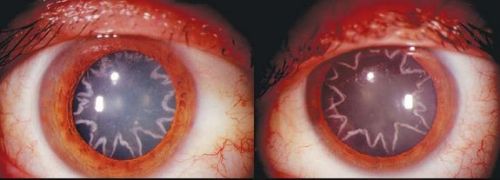 congenitaldisease:The eyes of a California electrician, who developed star shaped cataracts after be