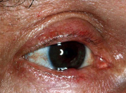voulx:  Types of Rosacea: Eye Irritation