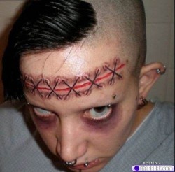 lobotomy scar