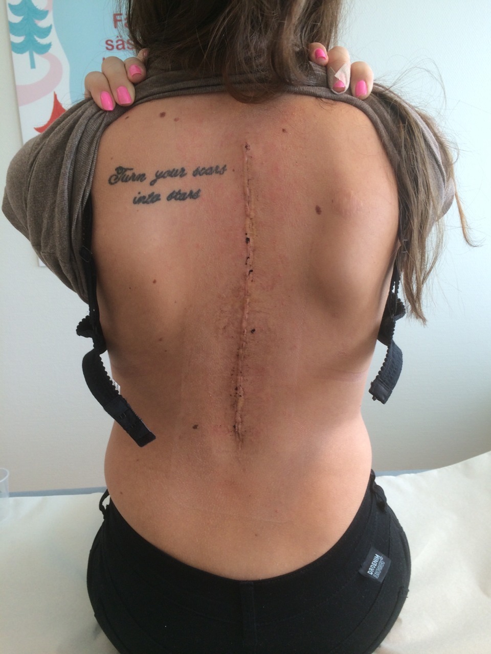 spine tattoo on scoliosisTikTok Search