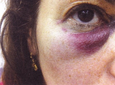 mandarinturtle:  Tracey Emin: Self portrait with Black Eye, BlackBerry Photo Diary,