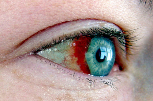 bloody eye by jennie333 on Flickr.
