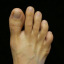 mortonsfeet