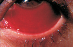 deformutilated:  Subconjunctival hemorrhage