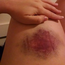 Craziest bruise I&rsquo;ve ever had. #HikingOnWobblyRocks