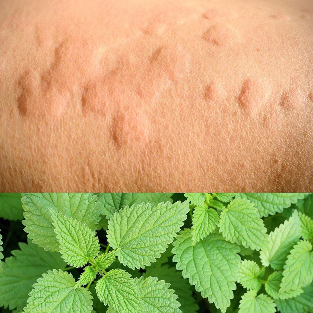 <p>😫 Hives 😫<br/>
.<br/>
With the changing season many are suffering with urticaria - more commonly known as “hives”<br/>
.<br/>
Homeopathic remedy Urticaria (stinging nettle) is a must for the medicine cabinet this time of year 😊<br/>
.<br/>
Great for calming that raised,  SUPER itchy rash in no time<br/>
.<br/>
Why not contact me to see how homeopathy can help with your summertime allergies?<br/>
.<br/>
(Acute consultations €40 including remedies)<br/>
.</p>

<p>#allergies #nettlestings #urticaria #skinaggravation #summerallergies #allergyseason #homeopathyfornettlestings #homeopathyforallergies #homeopathyhelps #homeopathy #irishhomeopath🇮🇪<br/>
<a href="https://www.instagram.com/p/CAsTO01lLZ1/?igshid=127okgrjtmypy">https://www.instagram.com/p/CAsTO01lLZ1/?igshid=127okgrjtmypy</a></p>