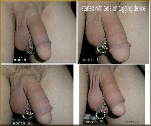 ban-ric:  (These pictures aren’t mine, here is the source)If you’re ever feeling disappointed about being circumcised, you can always restore your foreskin like the man in the pictures above did. It only took him 2 years to achieve the last picture,