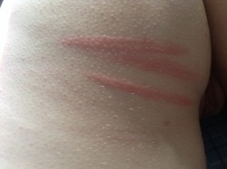 mastersnaughtykitty:  New cane marks and I’m still healing from Tyler and the freaking whip