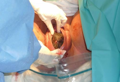 omgbirtish:Mmm…push a little bit more, it’s about to fully crown.