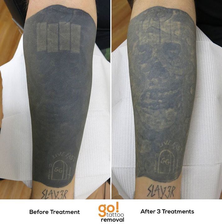 Tattoo Removal Cost  Methods An Honest Review 2021