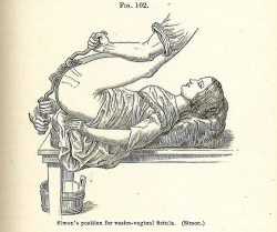 dasflutemk2:Victorian gynecological exam, c. 1880. 