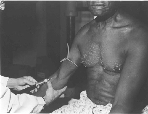 Bad Blood in Tuskegee — The Tuskegee Syphilis StudyBack in the day syphilis was a very deadly 